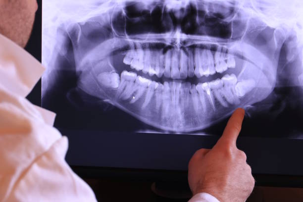 Best Emergency Tooth Extraction in Ferdand, IN