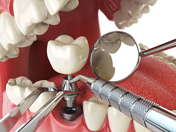 Best Emergency Tooth Extraction in Ferdand, IN